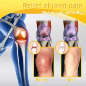 Super Deal ODALIT™ Botulinum Toxin & Bee Venom Pain-Relief Bone Healing Cream