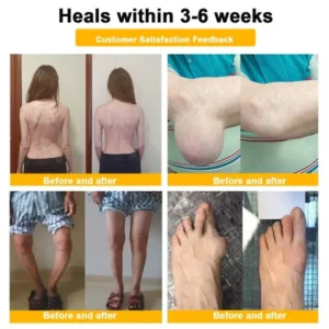 Super Deal ODALIT™ Botulinum Toxin & Bee Venom Pain-Relief Bone Healing Cream