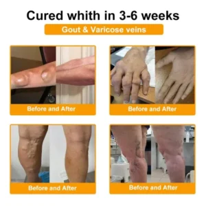 Super Deal ODALIT™ Botulinum Toxin & Bee Venom Pain-Relief Bone Healing Cream