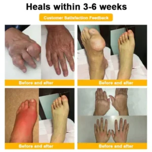 Super Deal ODALIT™ Botulinum Toxin & Bee Venom Pain-Relief Bone Healing Cream