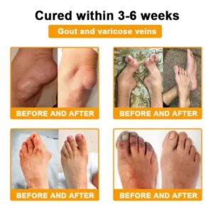 Super Deal ODALIT™ Botulinum Toxin & Bee Venom Pain-Relief Bone Healing Cream