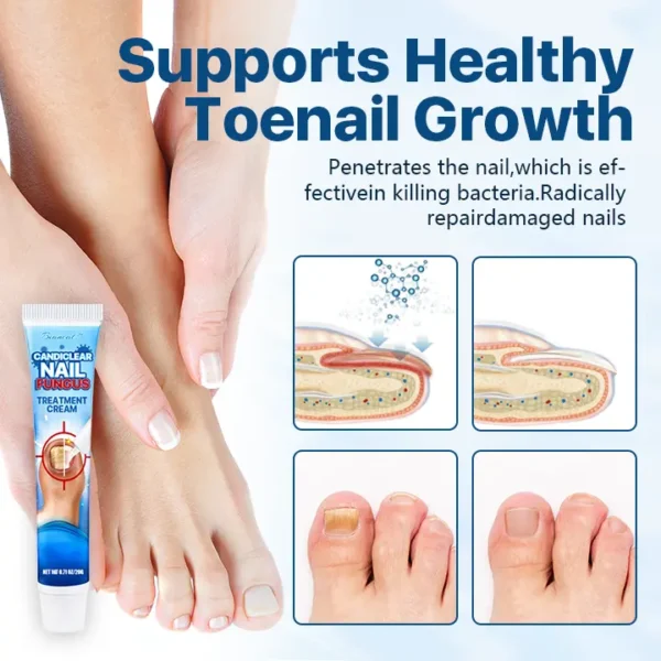 Biancat® Candiclear Nail Fungus Treatment Cream🌟