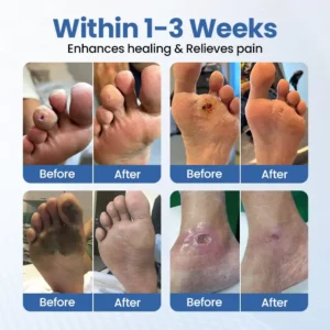 Biancat® VenHeal Bee Venom Diabetic Wound Spray