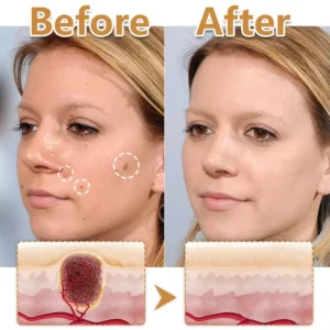 Biancat® BeeVenom Wart Drop Serum (A)