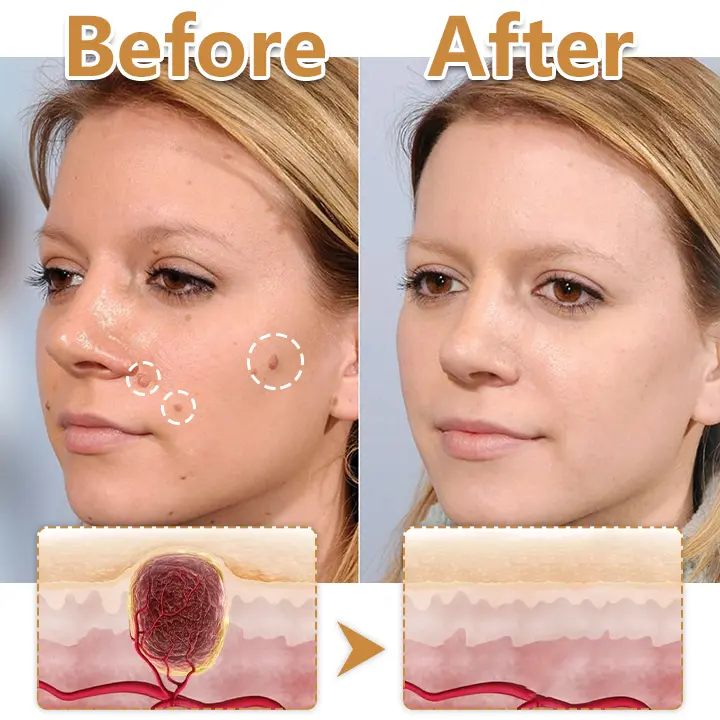 Biancat® BeeVenom Wart Drop Serum (A)