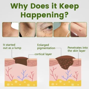 Timilk® ThujaClear Botanical Wart Cream