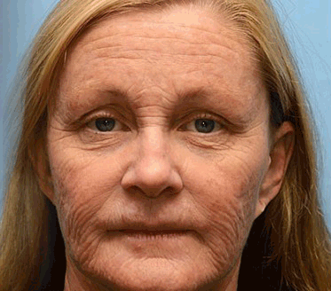 Rolimey® Botox & Vita-A Retinol Shot Tightening and Wrinkle-Reducing Cream