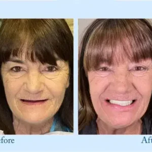 TrueEase™ Dentures