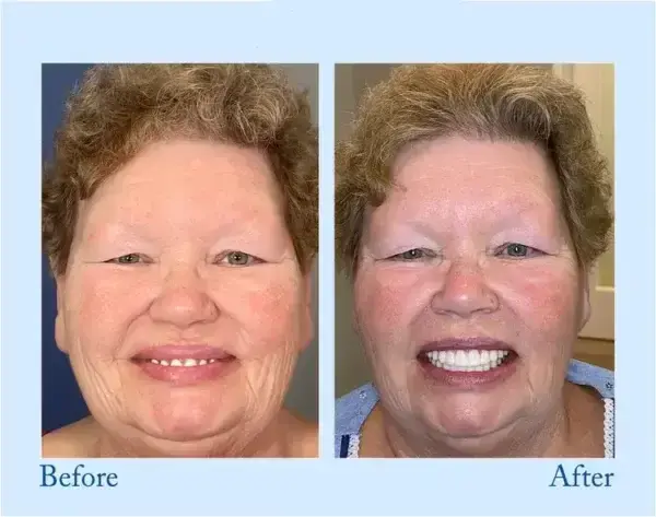 TrueEase™ Dentures