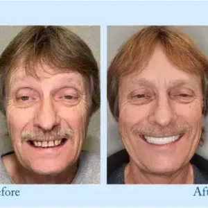 TrueEase™ Dentures